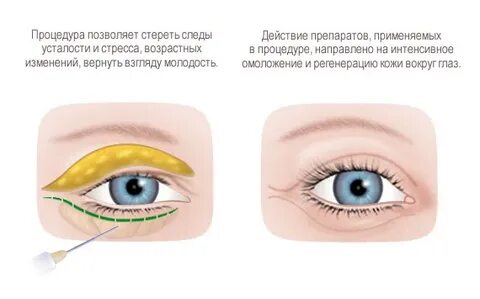 Делаю уколы в веки