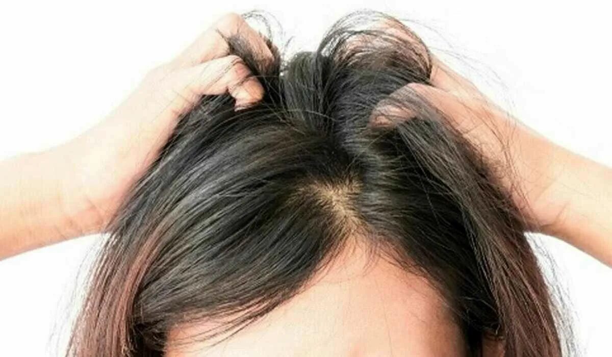 Сильный зуд кожи головы