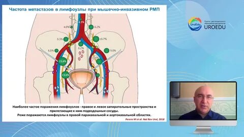 Лимфоузлы предстательной железы