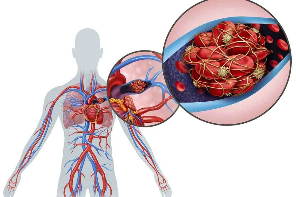 Тромбоэмболия легочной артерии. Тромб легочной артерии тромбоэмболия. Тромбоэмболия легочной артерии (Тэла). Тромбы в сосудах причины