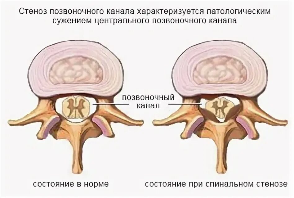 Сужение стеноз позвоночного канала. Дегенеративный спинальный стеноз l3-l4. Стеноз позвоночника классификация. Стеноз позвоночного канала l5. Стеноз спины.