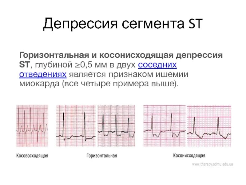 Депрессию инфаркт. Косовосходящая депрессия сегмента ст. Косонисходящая депрессия сегмента St на ЭКГ. Депрессия сегмента St косонисходящего типа. Подъема сегмента St в отведениях v1-v3.