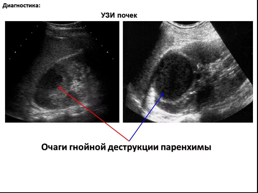 Узи почек диагнозы. Абсцесс почки УЗИ картина. Карбункул почки УЗИ картина.