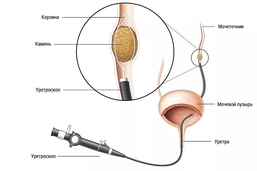 Камень больно. Уретроскопия камни в мочеточнике. Контактная литотрипсия камней мочеточника. Контактная литотрипсия камней мочевого пузыря, мочеточника. Трансуретральная контактная литотрипсия.