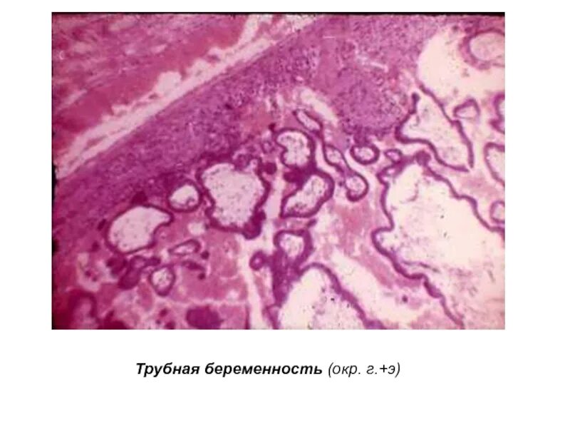 Гистология при беременности. Трубная беременность патологическая анатомия микропрепараты. Трубная беременность патанатомия. Трубная беременность микропрепарат патанатомия. Трубная беременность гистология.
