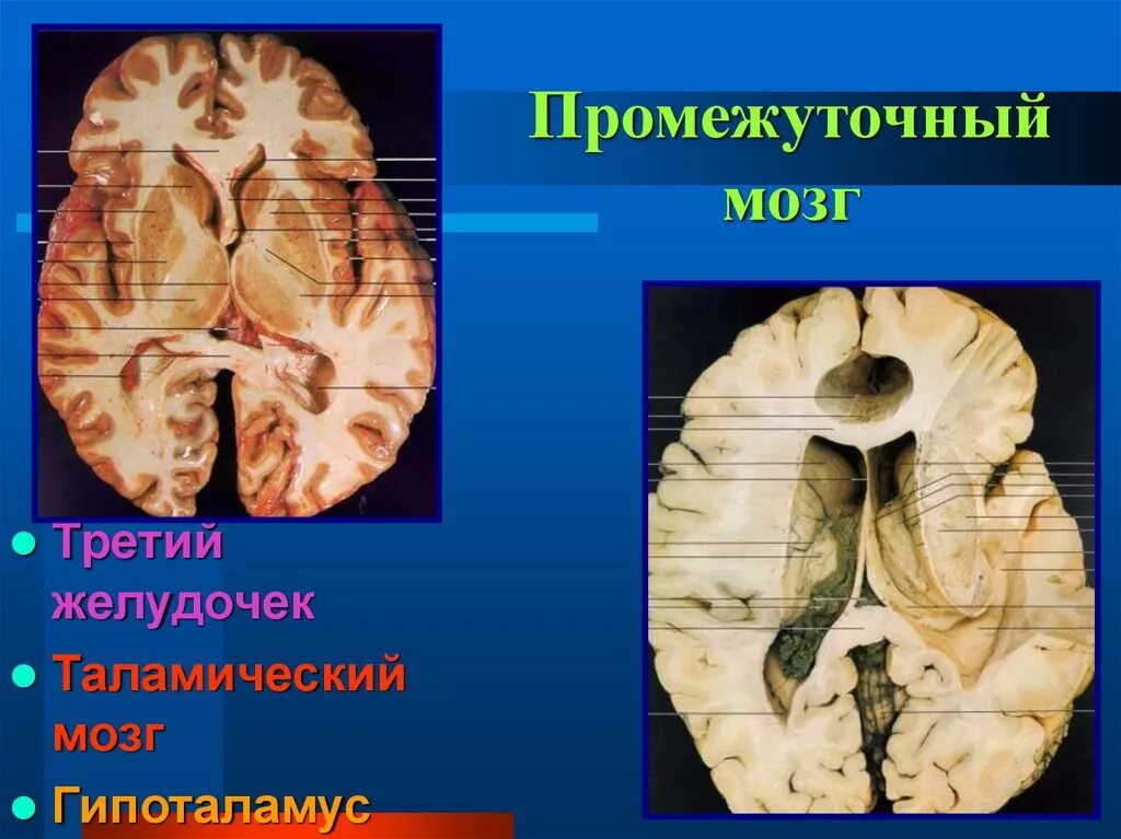 Средний мозг желудочек