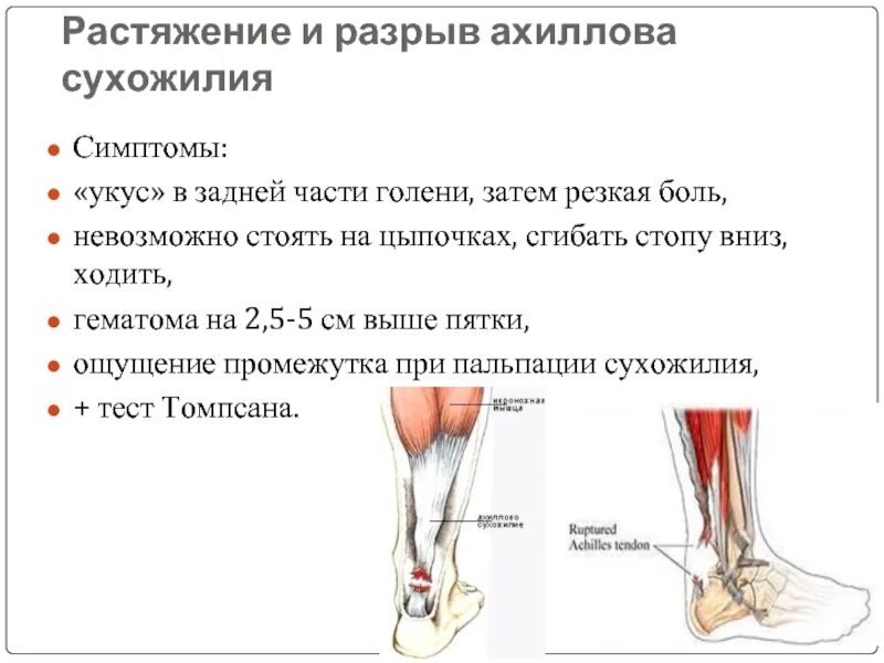 Боль в ногах от бедра до стопы. Растяжение ахиллова сухожилия УЗИ. Ахиллово сухожилие растяжение. Ахиллово сухожилие разрыв ахиллова сухожилия. Ультразвуковая анатомия ахиллова сухожилия.