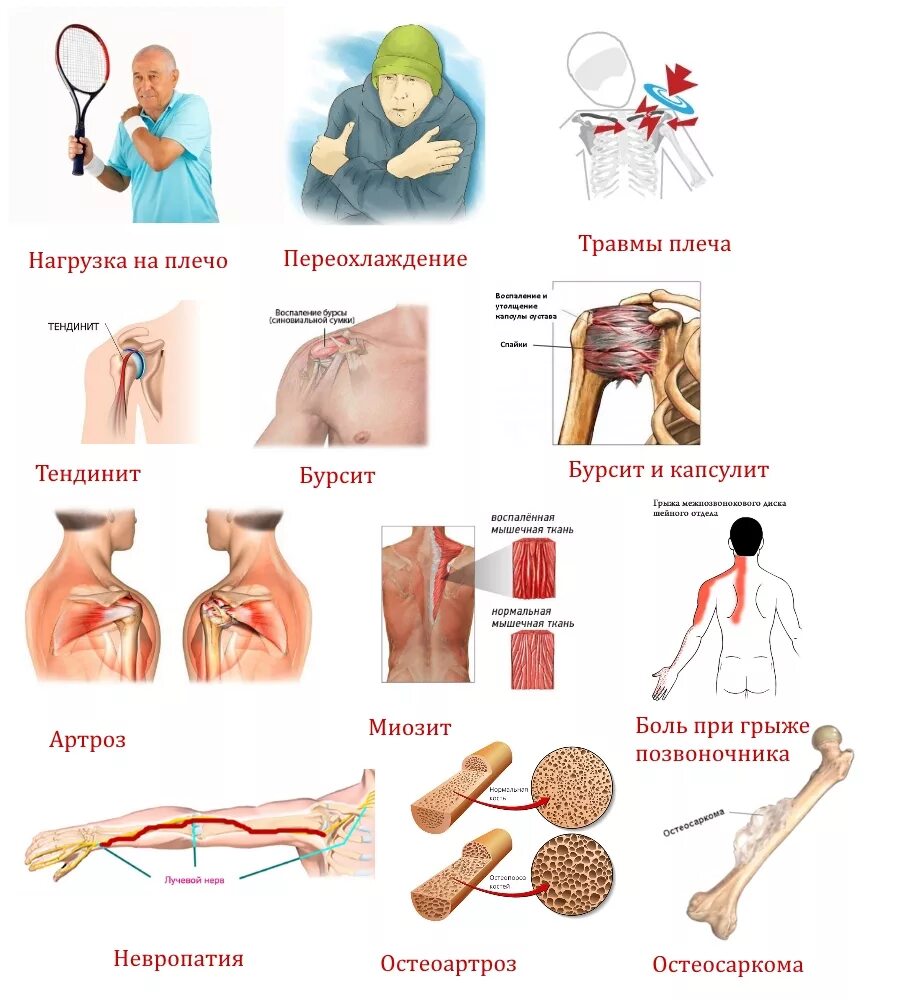 Очень сильно болят руки. Болит рука от плеча до локт. Болит левое плечо и рука.