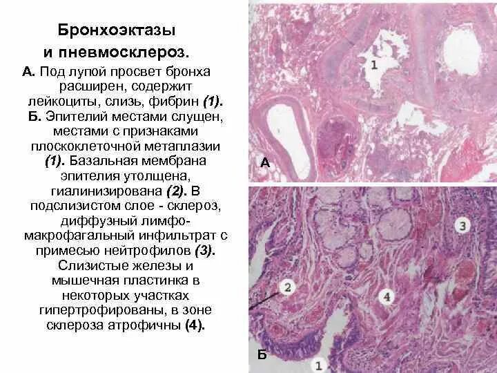 Пневмосклероз как лечить отзывы. Бронхоэктатическая болезнь гистология. пневмофиброз патологическая анатомия. пневмосклероз патологическая анатомия. пневмосклероз макропрепарат описание.