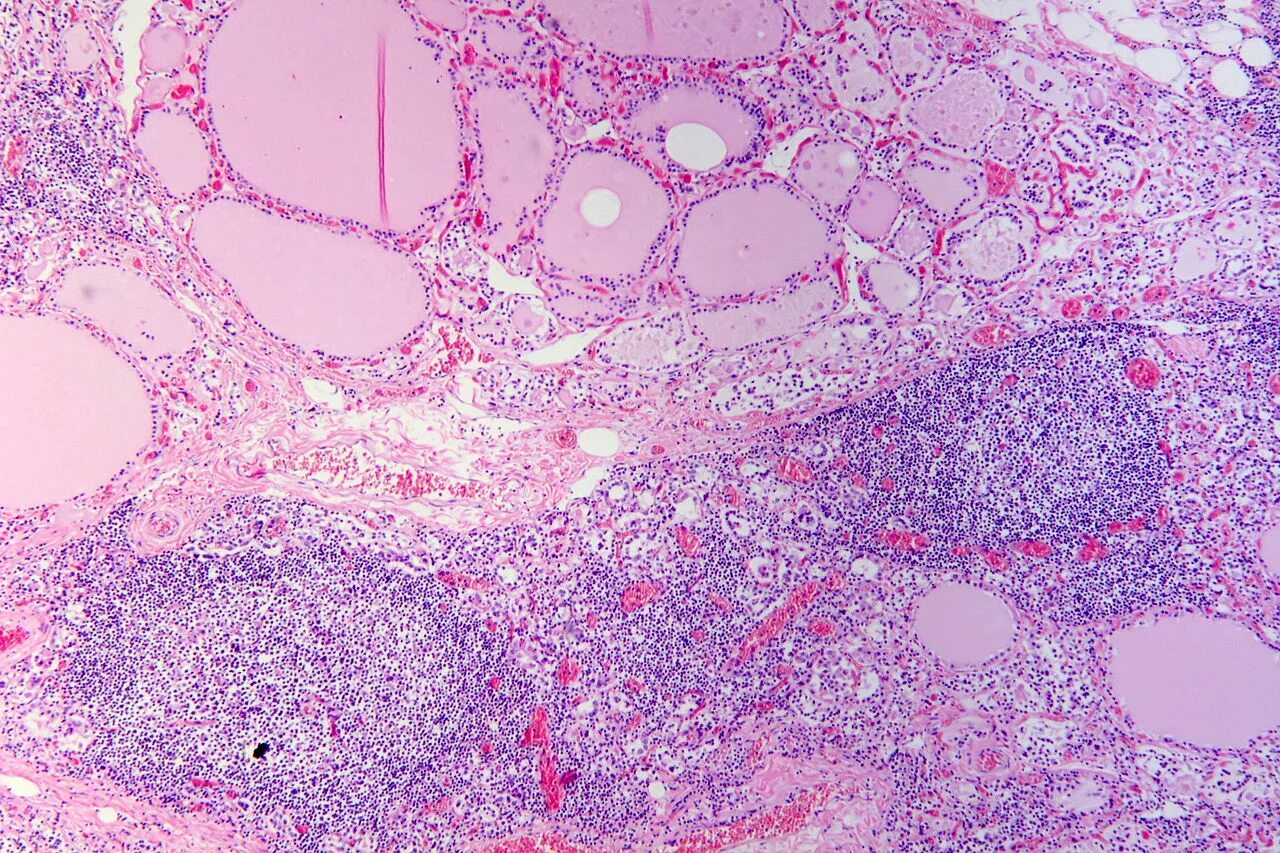 Зоб Хашимото гистология. Тиреоидит Хашимото гистология. Болезнь Хашимото гистология. Аутоиммунный тиреоидит зоб Хашимото микропрепарат.