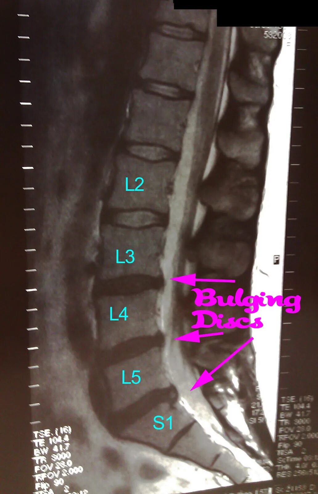 Протрузия дисков l2 l3 l4 l5. Протрузия диска l4-s1. Диски l5-s1 в позвоночнике. Протрузия дисков l1-l2 что это такое. Диски l3-s1.