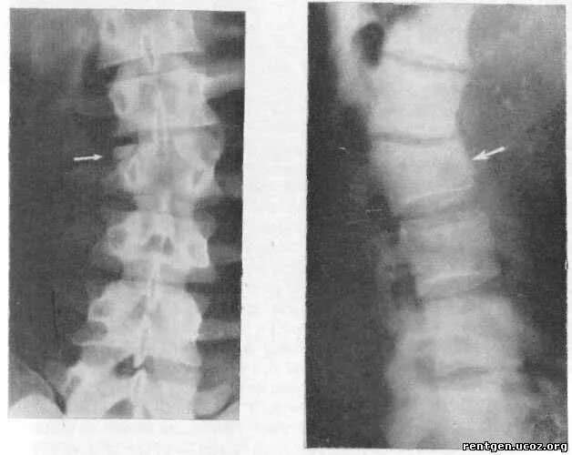 Компрессионный перелом позвоночника рентген. Компрессионный перелом позвоночника у детей рентген. Компрессионный перелом грудного отдела позвоночника рентген. Снимок компрессионного перелома позвоночника грудного отдела.