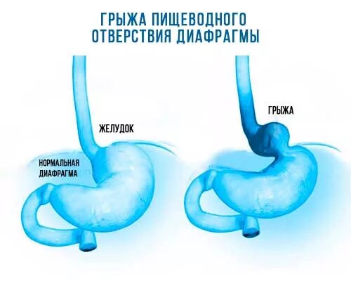 Грыжа пищевого отверстия диафрагмы диета. Диета при грыже пищеводного отверстия. При грыже пищеводного отверстия. Диета при грыже пищеводного отверстия желудка.