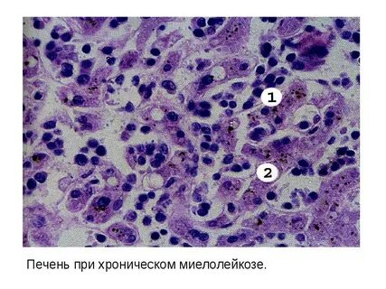 Печень при остром лейкозе