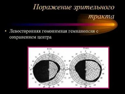 Поражение зрительных путей