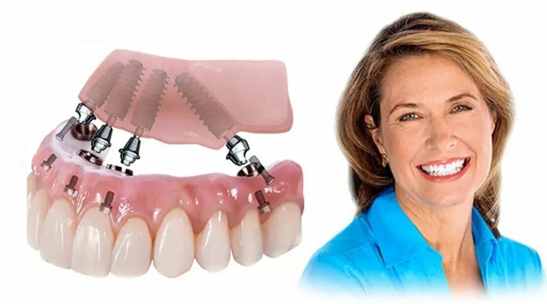 All on 6 цена. Имплантация зубов по технологии «all on 4». Протезирование и имплантация по технологии «all-on-4» Nobel Biocare.