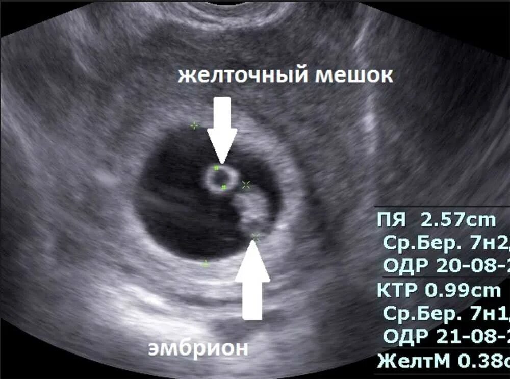 5 недель можно делать. УЗИ 6 недель беременности желточный мешок. Плодное яйцо с эмбрионом и желточным мешком. УЗИ плодного яйца на 5 неделе беременности. Плодное яйцо на 6 неделе беременности УЗИ.