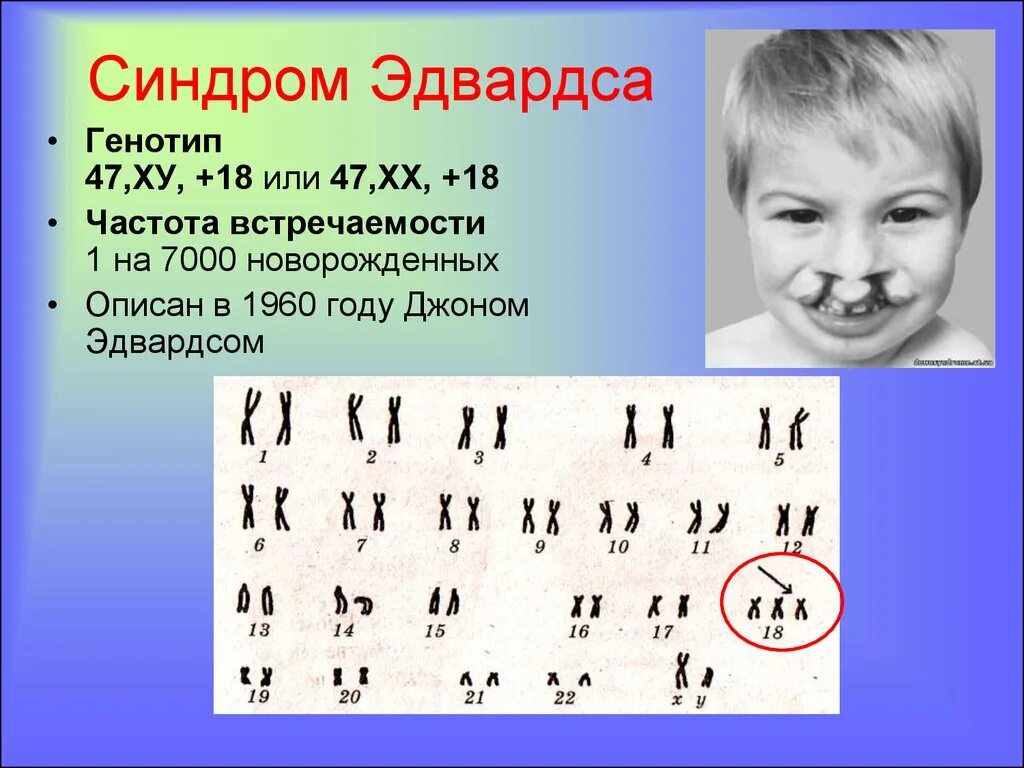 Синдром дауна генотип и фенотип. Синдром эдвардса кариотип. эдвардс синдром кариотип. кариотип больного с синдромом эдвардса. синдром эдвардса хромосомная формула.