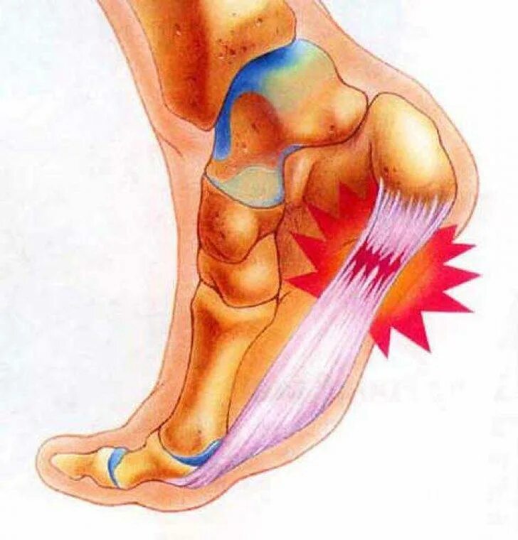 Середина стопы. Плантарный фасциит стопы. Воспаление плантарный фасциит. Плантарный апоневроз стопы.