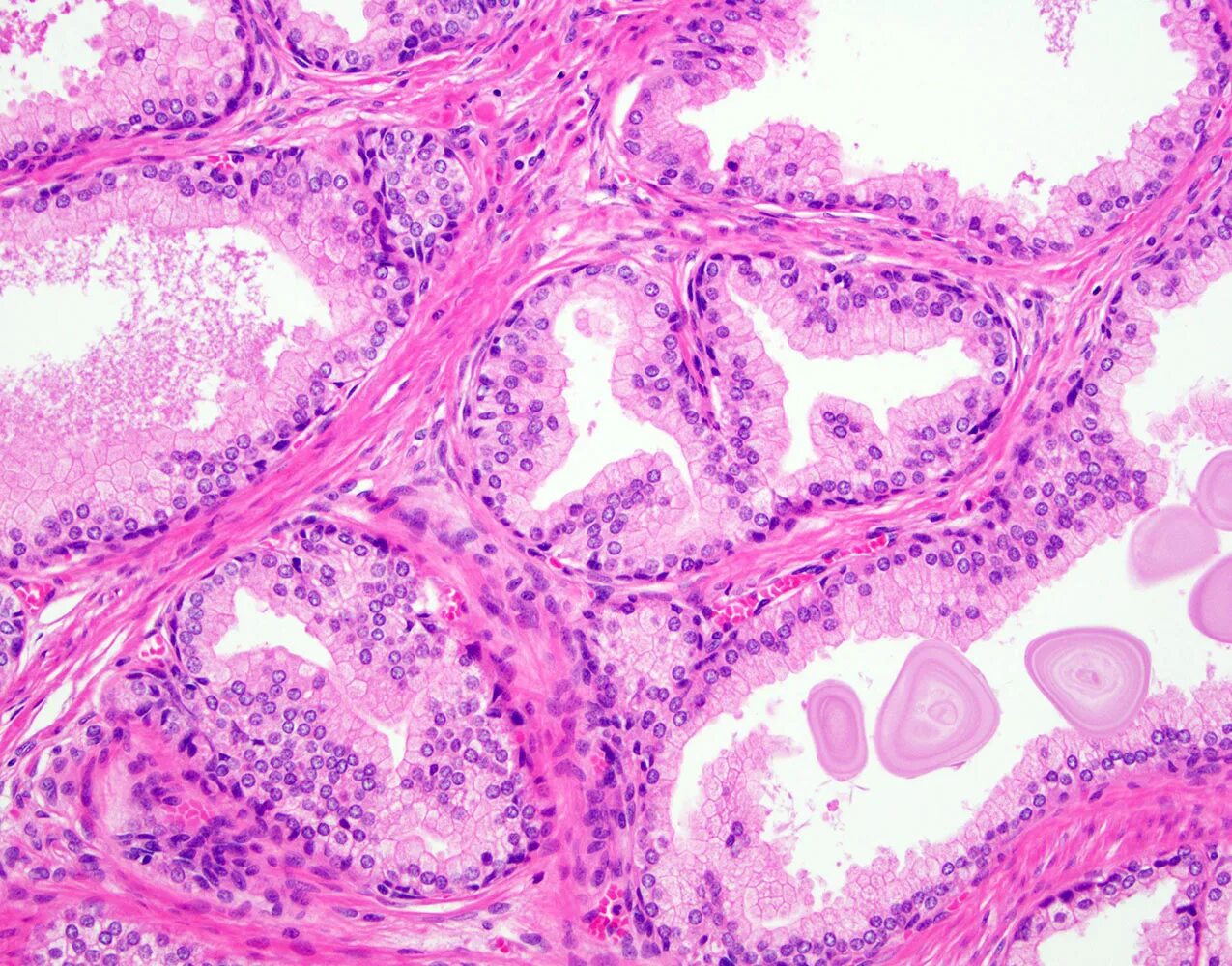 Prostatic hyperplasia.