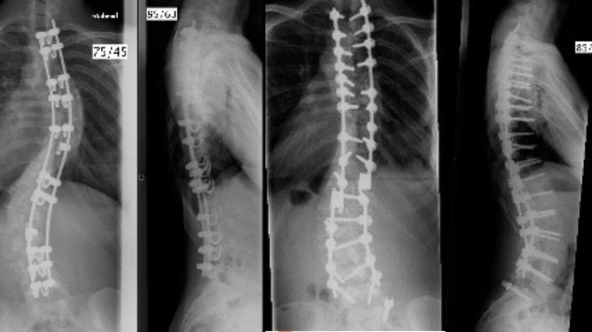 Сколиоз операция рентген. Левосторонний сколиоз рентген. Операция на позвоночник сколиоз 2 степени. Сколиоз 4 степени рентген. 2 операции на позвоночнике