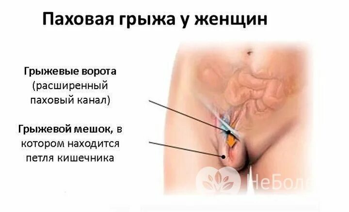 Паховая грыжа что можно кушать. Паховая грыжа лапароскопическим методом. паховая грыжа у женщин в области лобка. паховая грыжа лапароскопия. грыжа в паховой области у женщин.
