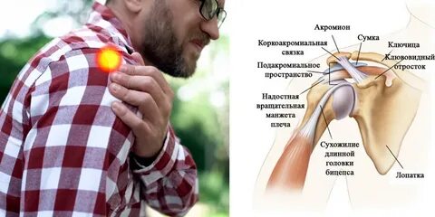Хруст в плечевом суставе при вращении
