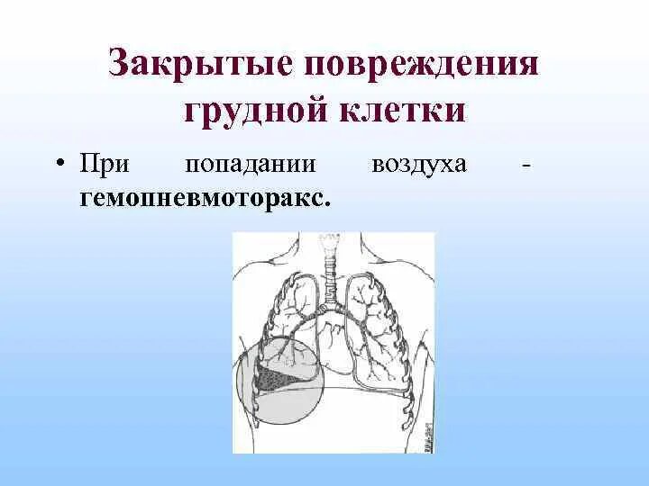 Закрытые и открытые повреждения грудной клетки. Правосторонний гемопневмоторакс. Закрытые повреждения грудной клетки. Гемопневмоторакс травматический.