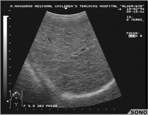 Желчный пузырь эхогенность повышена. Подковообразная почка на УЗИ. УЗИ поджелудочной железы эхогенность неоднородная. Паренхима повышенной эхогенности поджелудочной железы что. Здоровая печень на УЗИ.