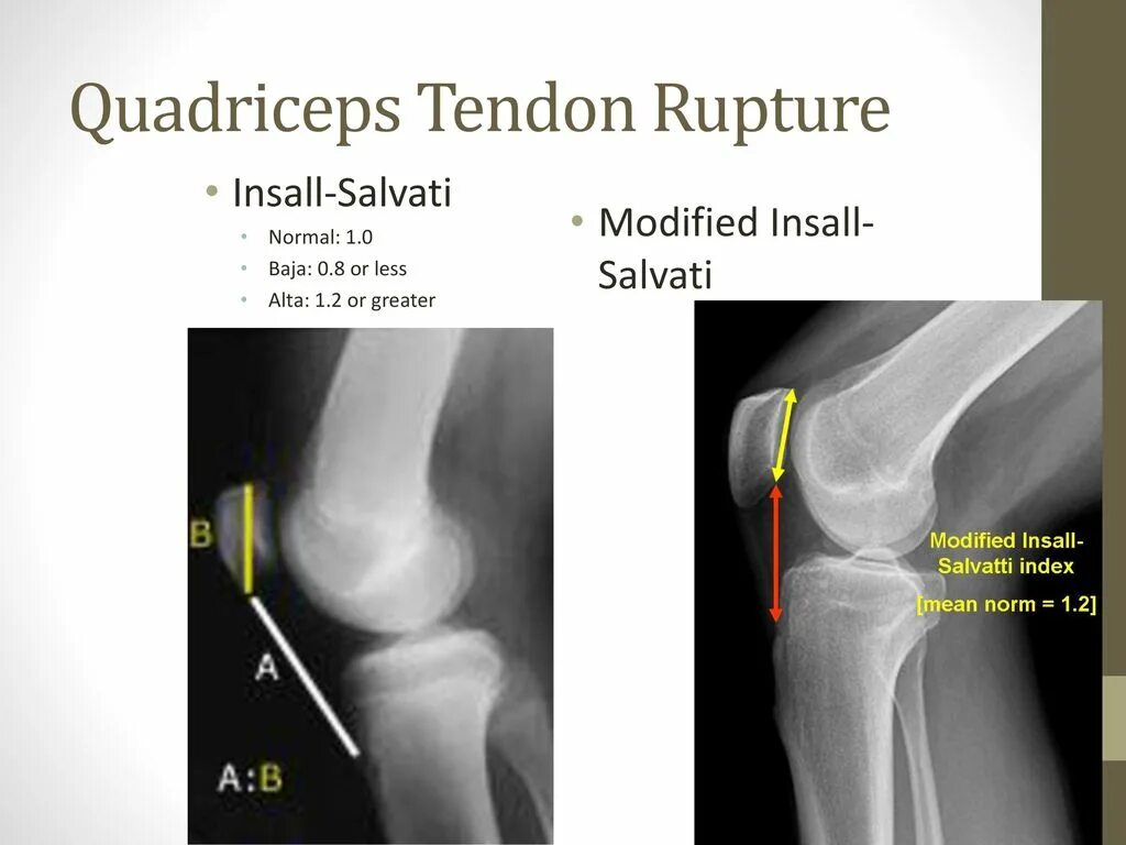 Колено прыгуна тендинит надколенника. Низкий надколенник. Patella alta индекс. Многооскольчатый перелом надколенника. Пателла альта коленного сустава.