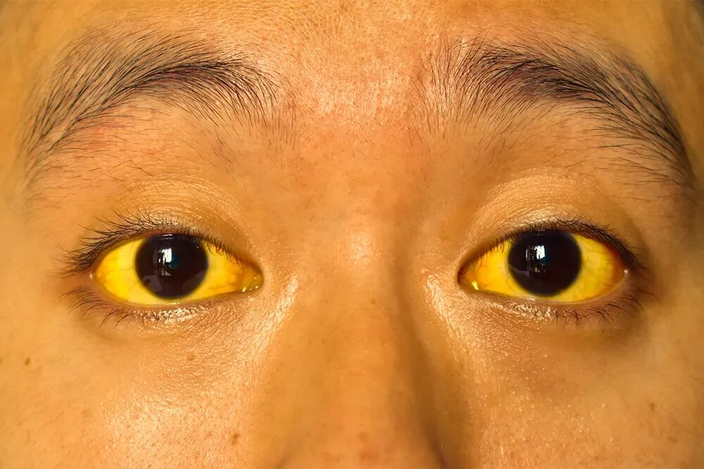 желтый человек болезнь. желтушный лептоспироз. желтый человек болезнь. жильбер пожелтение кожи. желтый человек болезнь.