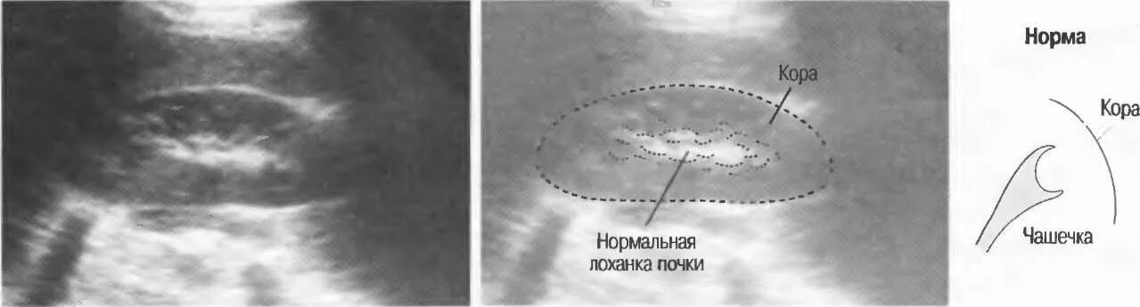 Узи лоханки почки. Размер лоханки почки норма. Нормальные Размеры почек. Нормальные Размеры лоханки почки. Лоханка в норме на УЗИ.