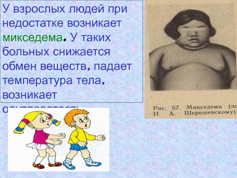 Заболевание возникающее при недостатке. Презентация на тему заболевание микседема. микседема температура тела. патологии возникающие при недостатке и избытке солей. микседема возникает при избытке.