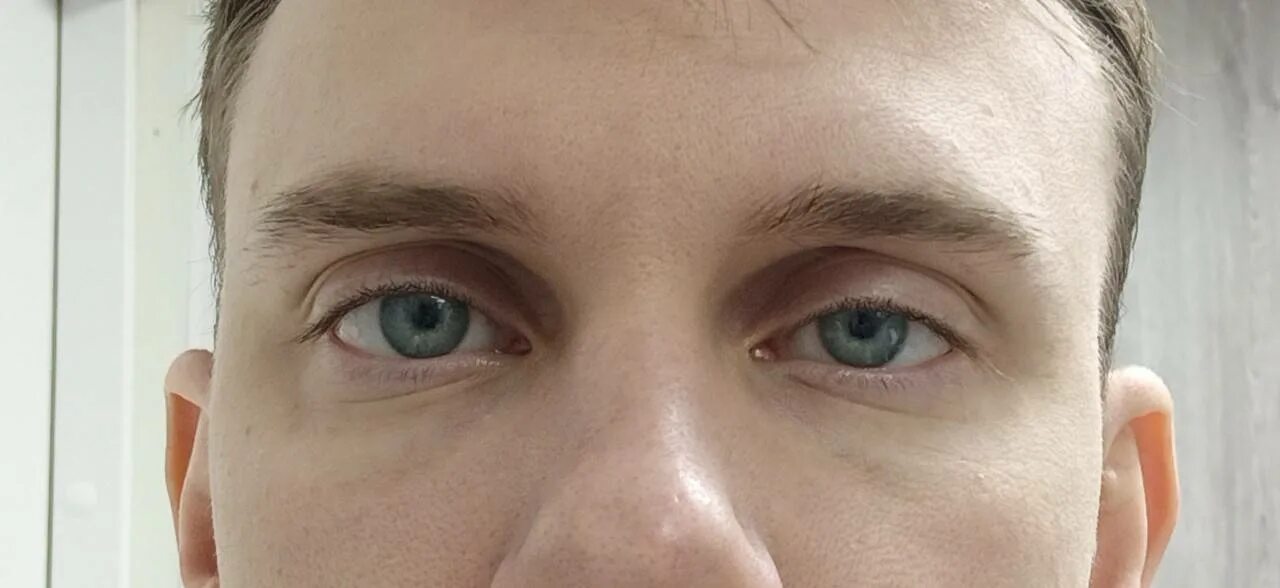 Блефарит конъюнктивит ячмень. Немного веко. Один глаз больше другого. Немного веко. Мейболитовый блефарит.