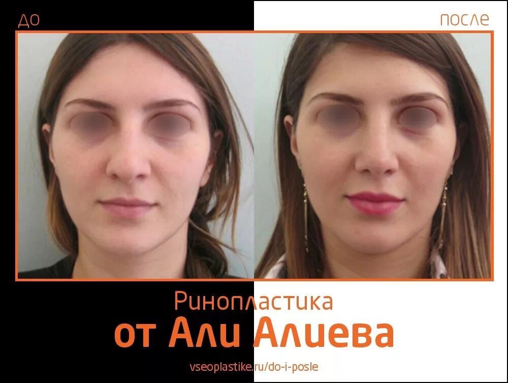 ольга шемонаева ринопластика. тимур алиев пластический хирург. риносептопластика алиев. алиев пластический хирург отзывы. гаджи раджабович ринопластика.