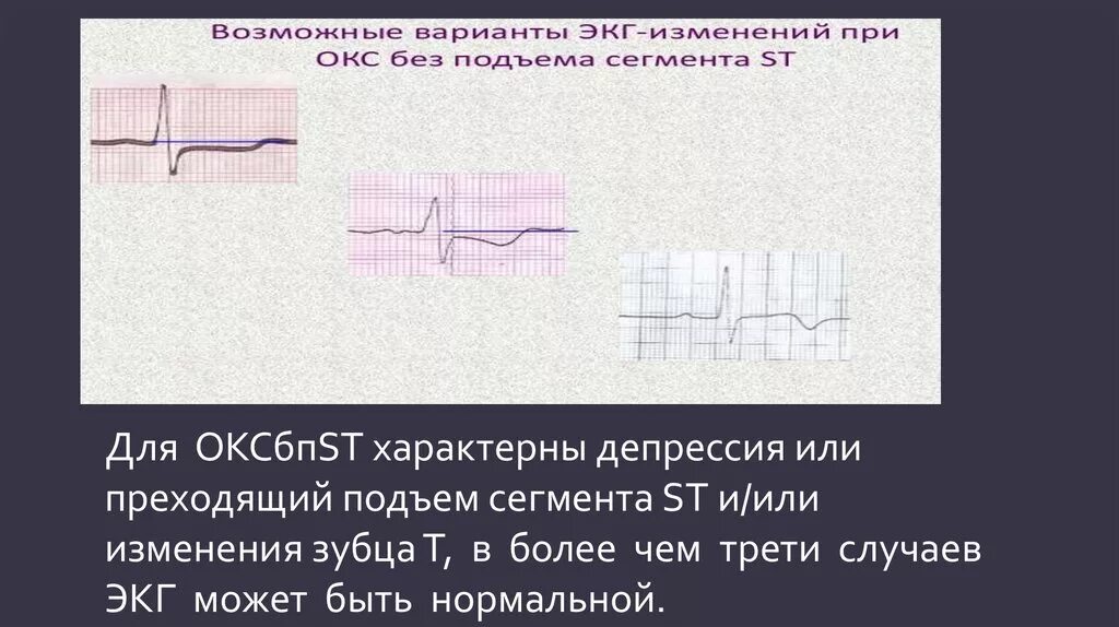 Острый коронарный синдром инфаркт. ЭКГ при инфаркте без подъема St. ЭКГ при инфаркте миокарда без подъема сегмента St. Окс без подъема St на ЭКГ. Инфаркт миокарда с подъемом сегмента ст ЭКГ.