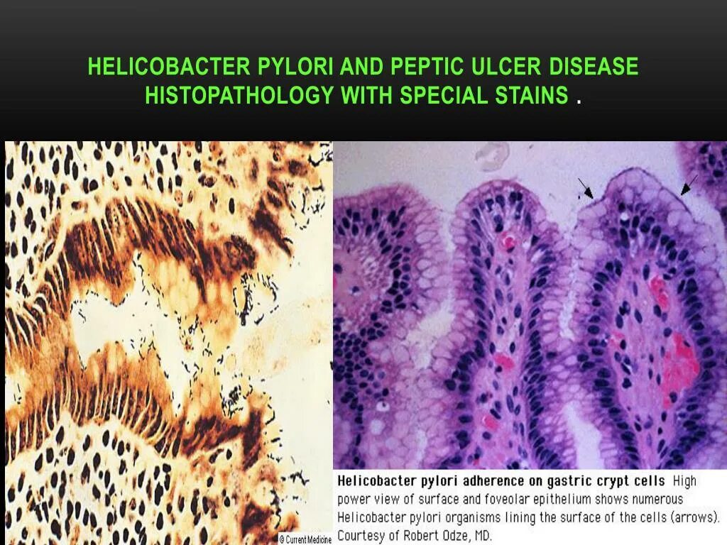 Хеликобактер пилори желудок гистология. Язва 12 перстной кишки гистология. Helicobacter pylori микроскопия. Хеликобактерный гастрит гистология.