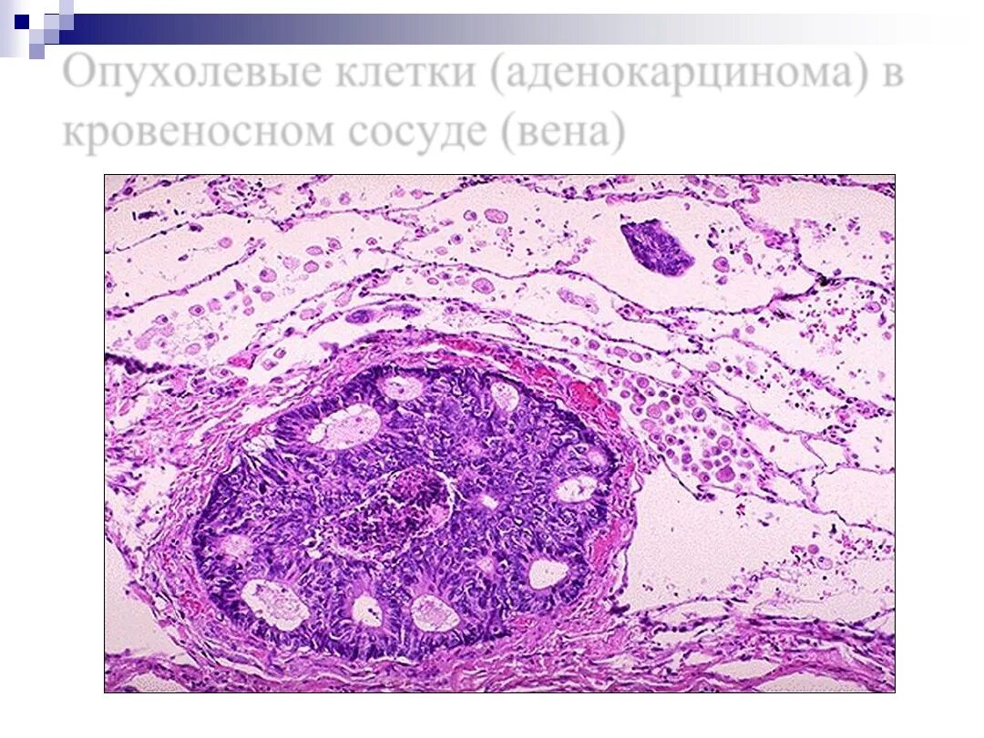 Рак молочной железы метастазы в легких. Атипичные клетки патанатомия. Опухолевые эмболы гистология. Печень гематоксилин эозин гистология.