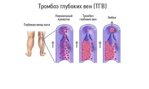 Лечение тромбоза глубоких вен