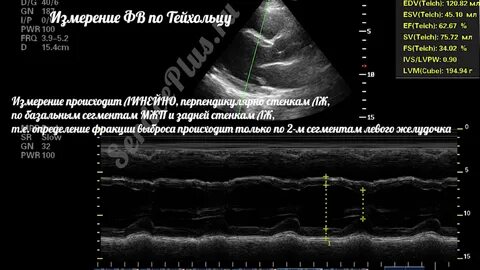 Фракция выброса по тейхольцу норма