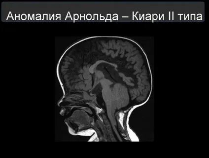 Что такое аномалия арнольда киари