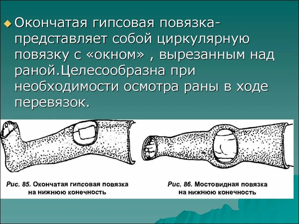 Гипсовая повязка. Лонгетно-циркулярная гипсовая повязка. Окончатая гипсовая повязка. Циркуляторные гипсовые повязки. Мостовидные гипсовые повязки.