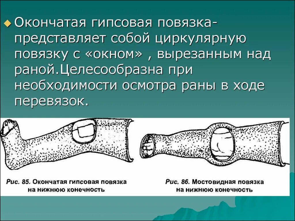 Лонгетно-циркулярная гипсовая повязка. Окончатая гипсовая повязка. Фиксирующая гипсовая повязка, 1811. Мостовидные гипсовые повязки. При открытом переломе накладывают