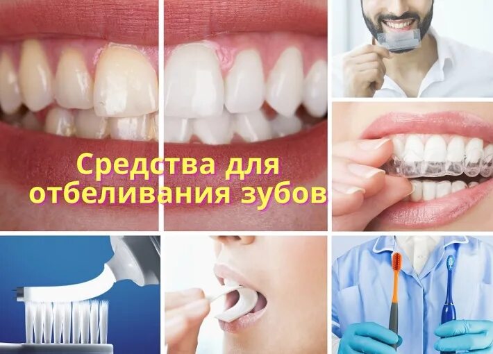 Перед отбеливанием. Отбеливание зубов до и после фото. Подготовка перед отбеливанием зубов.