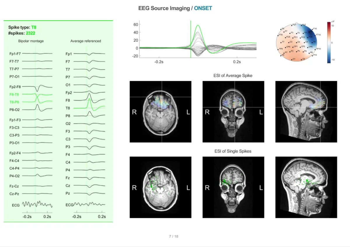 Электроэнцефалография головного мозга (ЭЭГ). ЭЭГ мониторинг с электродами. Визуальный анализ ЭЭГ. Схема прибора ЭЭГ. Ээг дневное ребенку