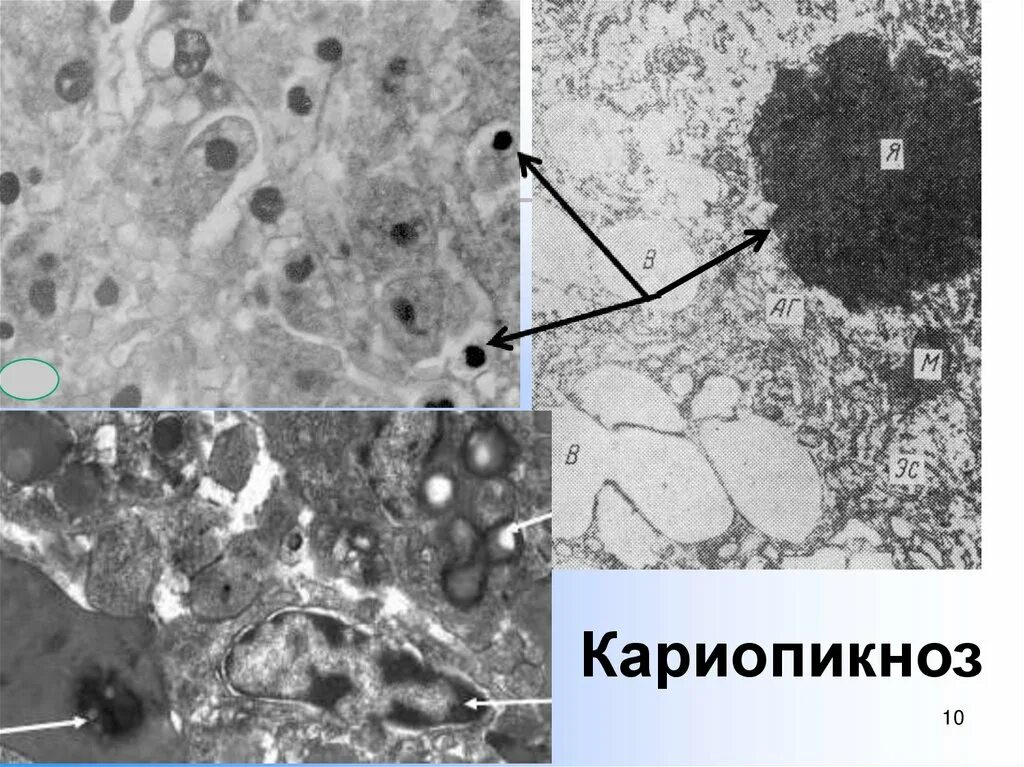 Кариопикноз это. Кариопикноз это в патологии. Пикноз ядра. Кариопикноз гистология.