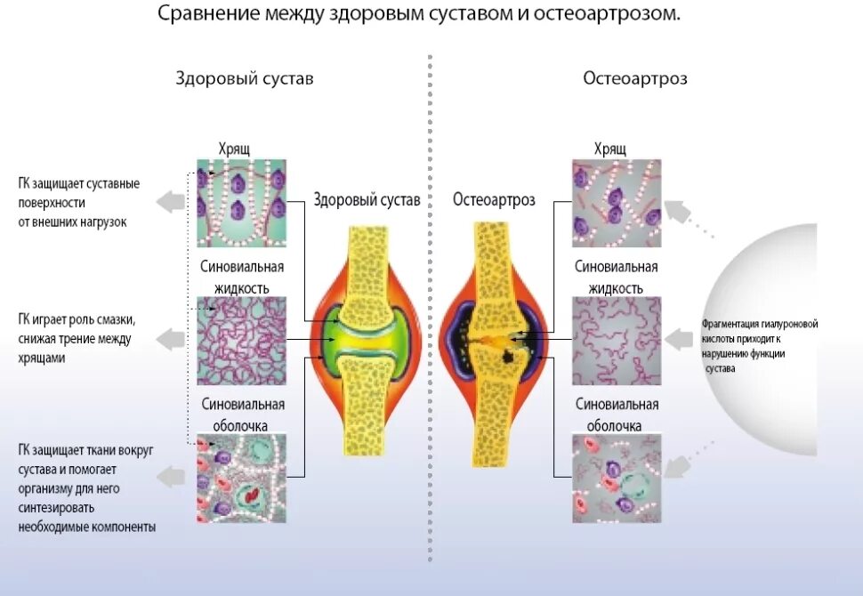 Оа суставов