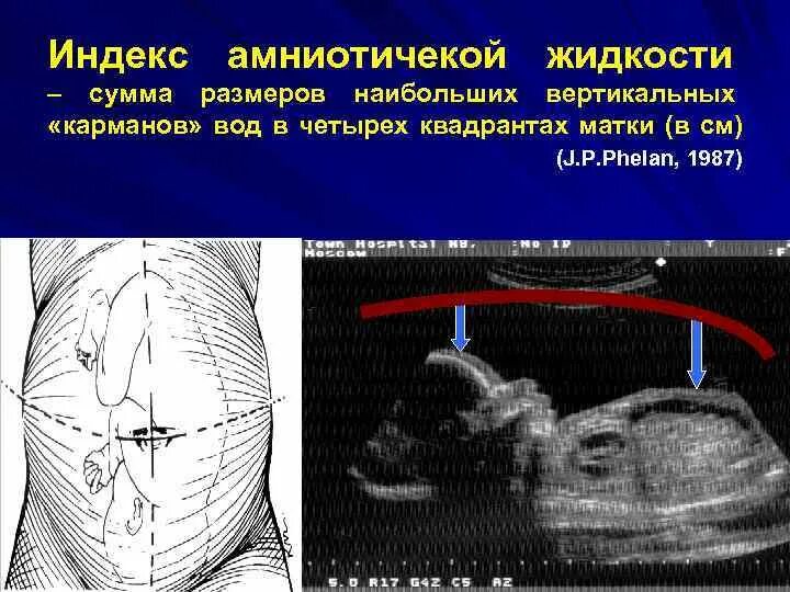 Иаж норма по неделям таблица Маловодие при беременности