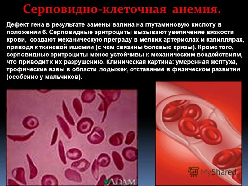Ген серповидноклеточной анемии. Серповидноклеточная анемия генная. Серповидноклеточная анемия показатели крови. Серповидноклеточная анемия эритроциты. Серповидноклеточная анемия Валин.