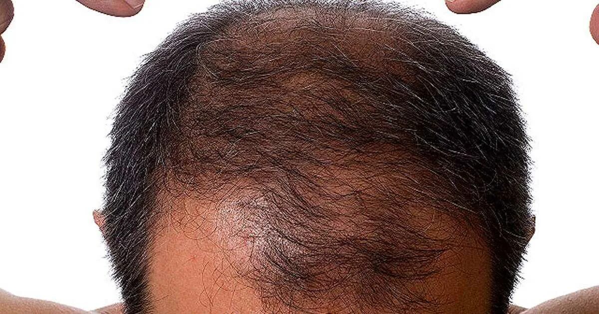 Волосы у мужчин на голове. Болят корни волос на макушке